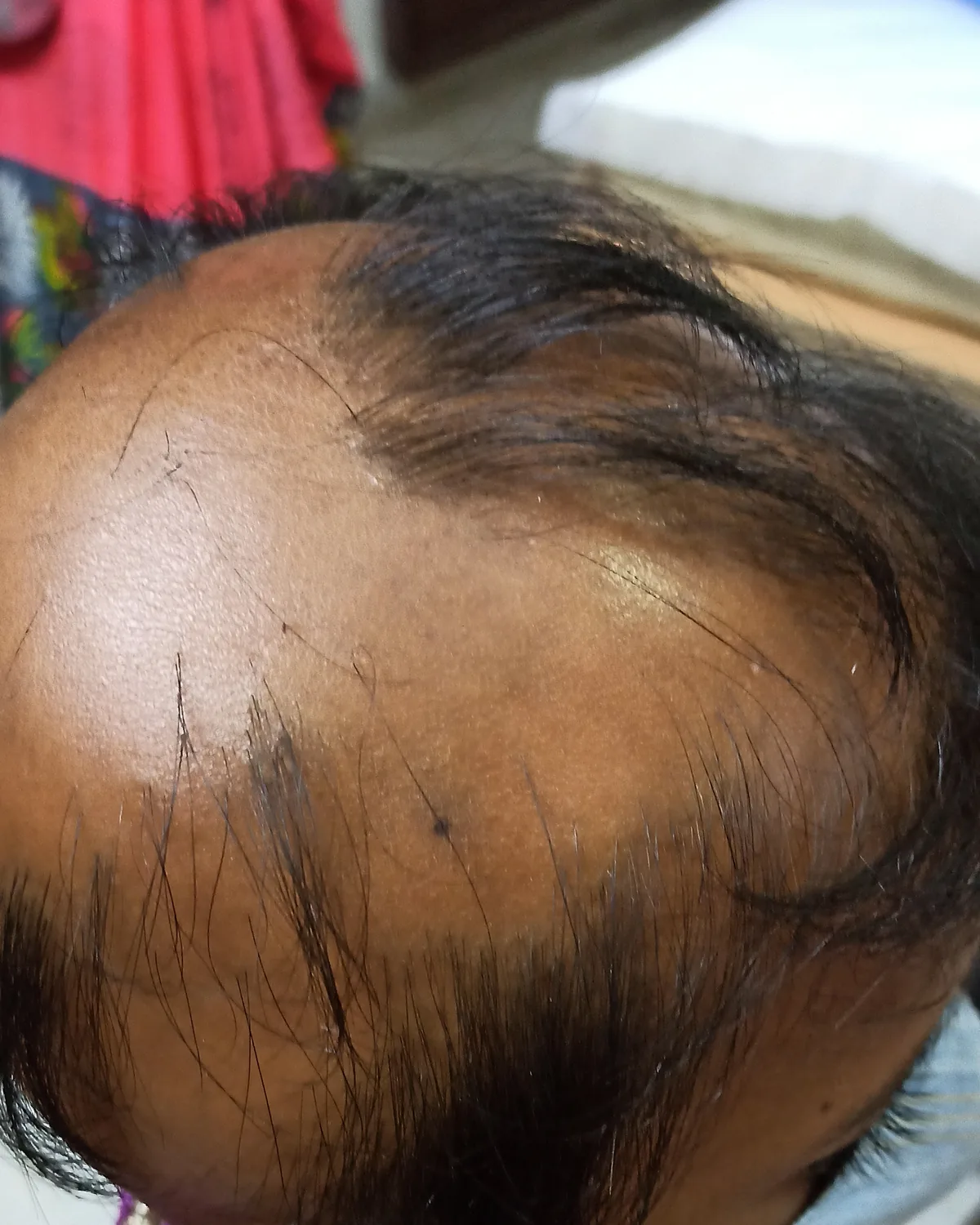 A child's scalp from above with widespread thinning, bare skin showing through across the crown and only wispy hair remaining.