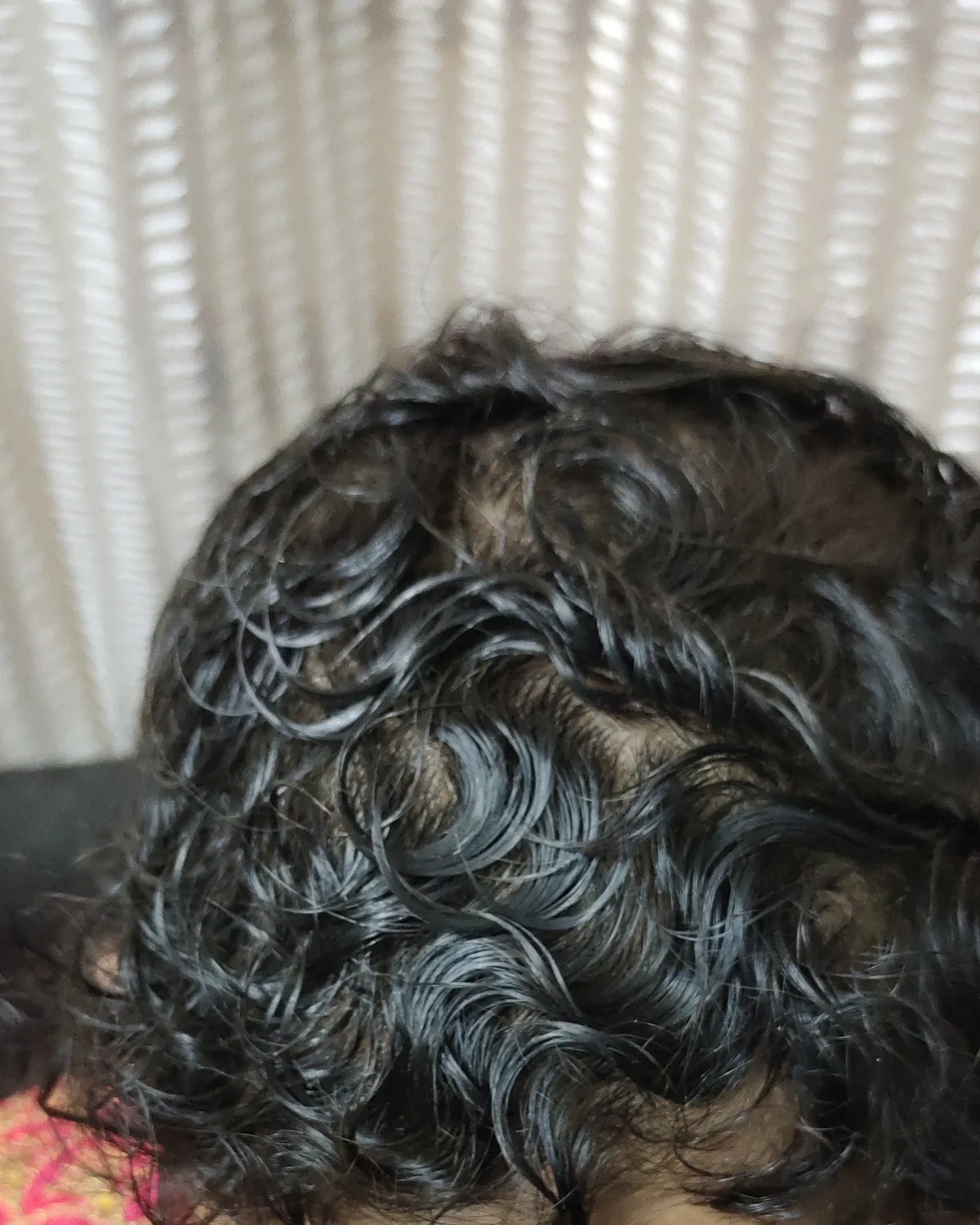 The top of the same scalp with a full head of dense, dark, curly hair. The frame is cropped above the brow.