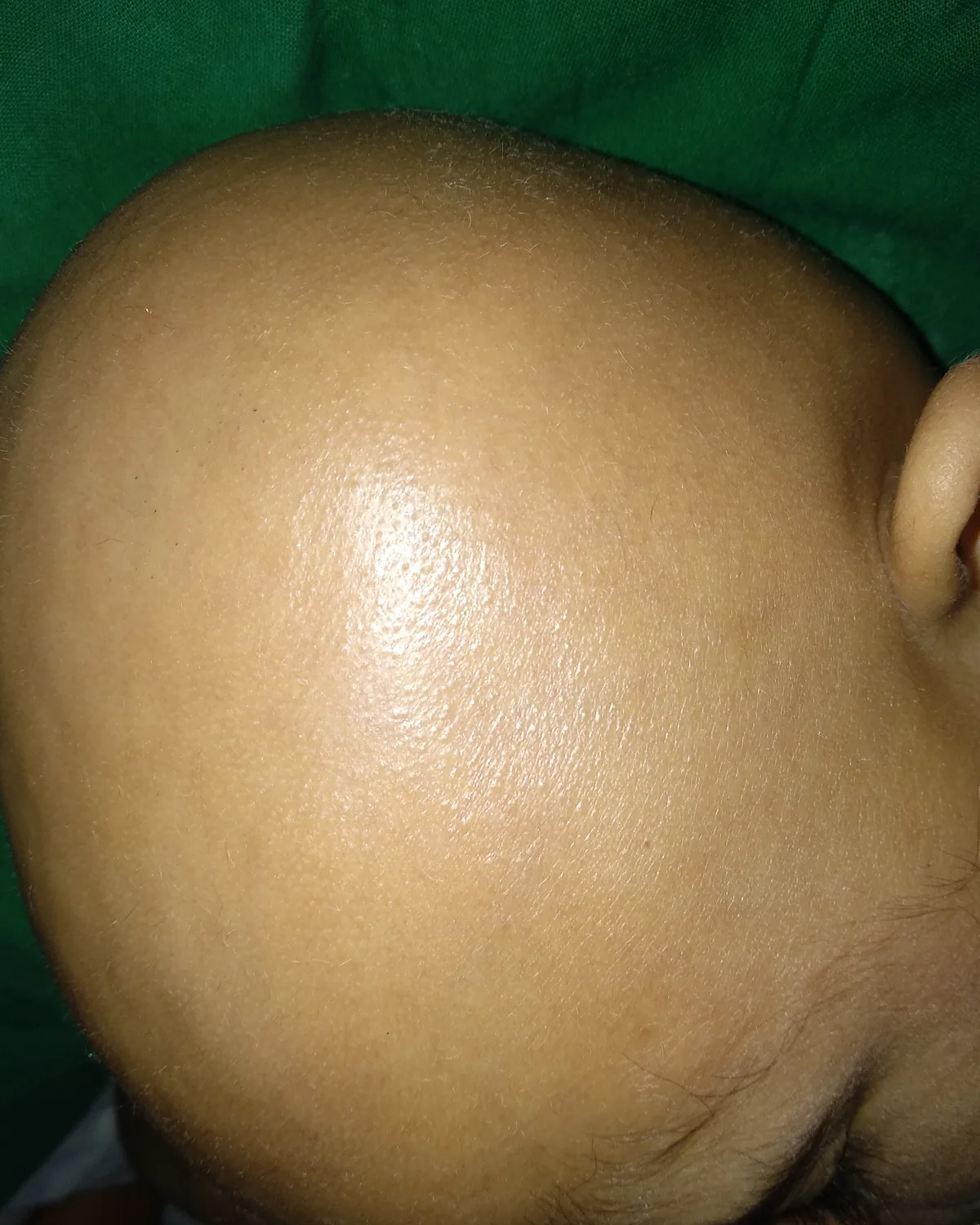 A child's scalp seen from the side, completely bald, with smooth skin and no visible hair follicles.