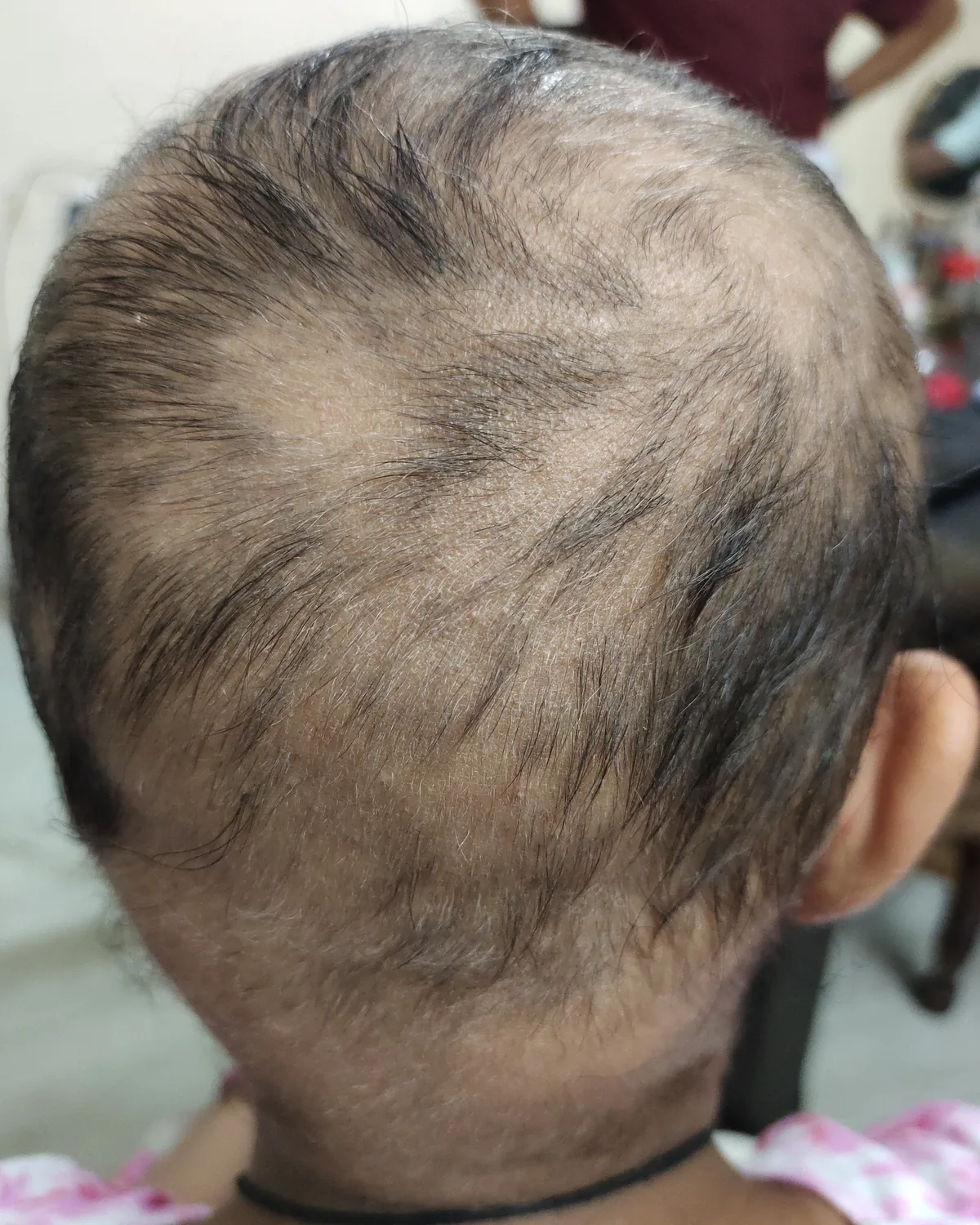 The back of the same scalp, now covered in short, fine, sparse hair of uneven density.