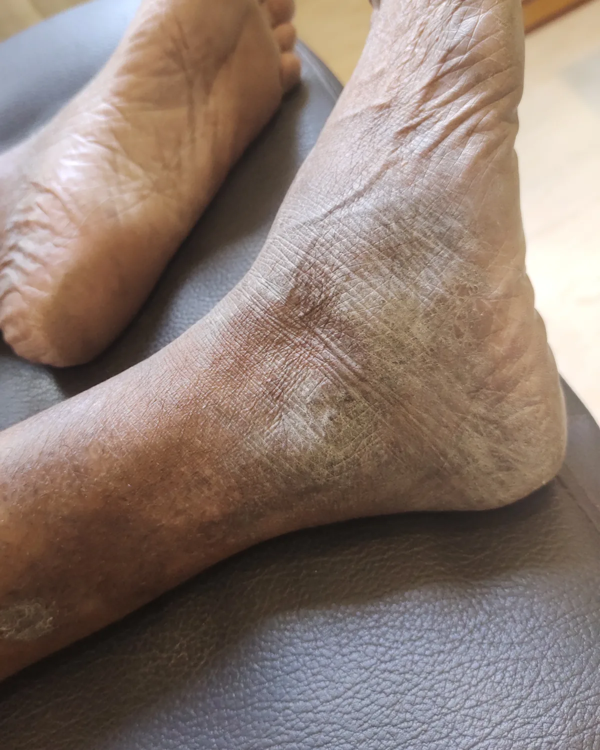 The same ankle with the scaling resolved and the skin smooth, leaving darker discolouration where it had been.