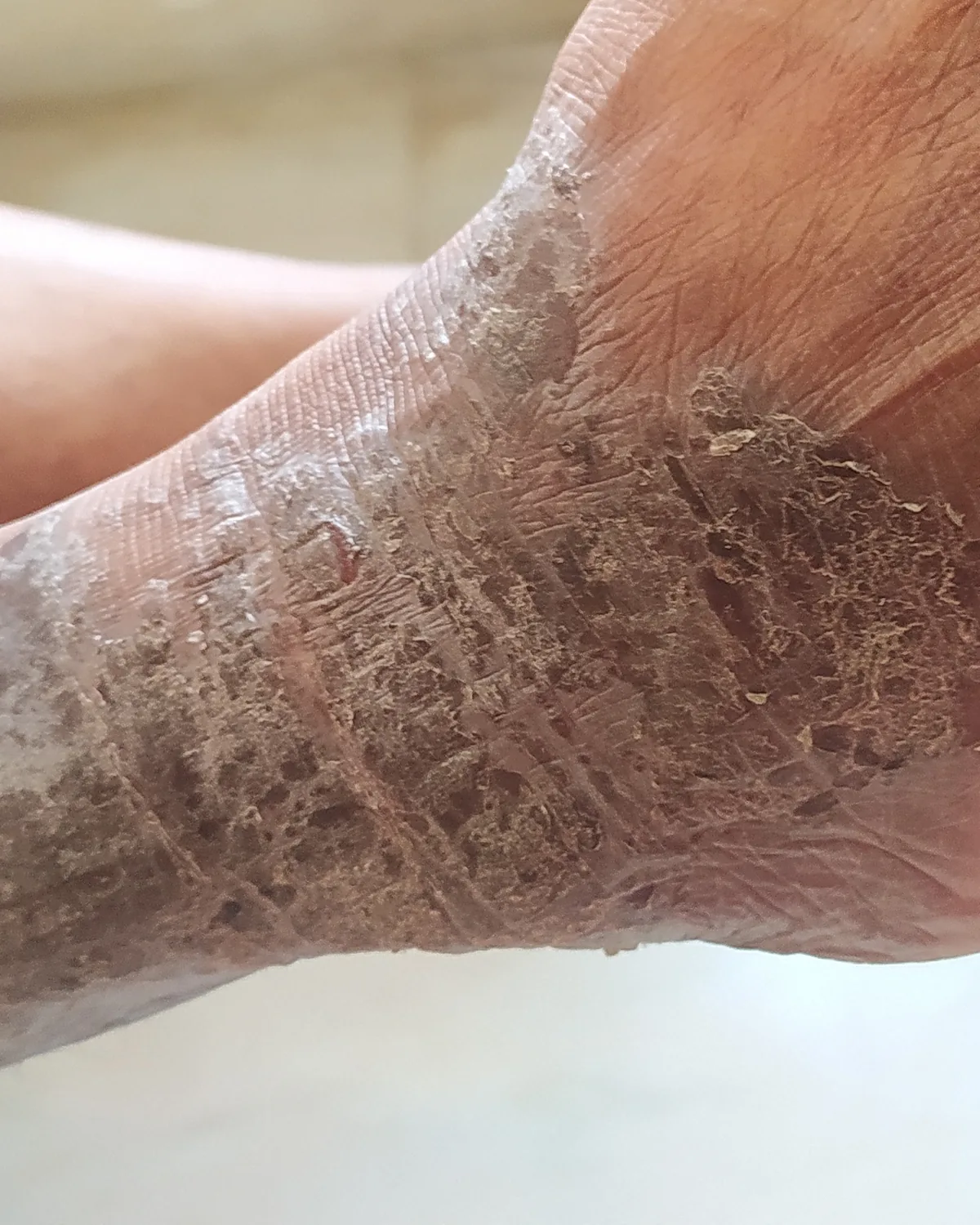 An ankle and foot with thickened, dry, heavily scaling skin broken into a coarse cracked pattern.