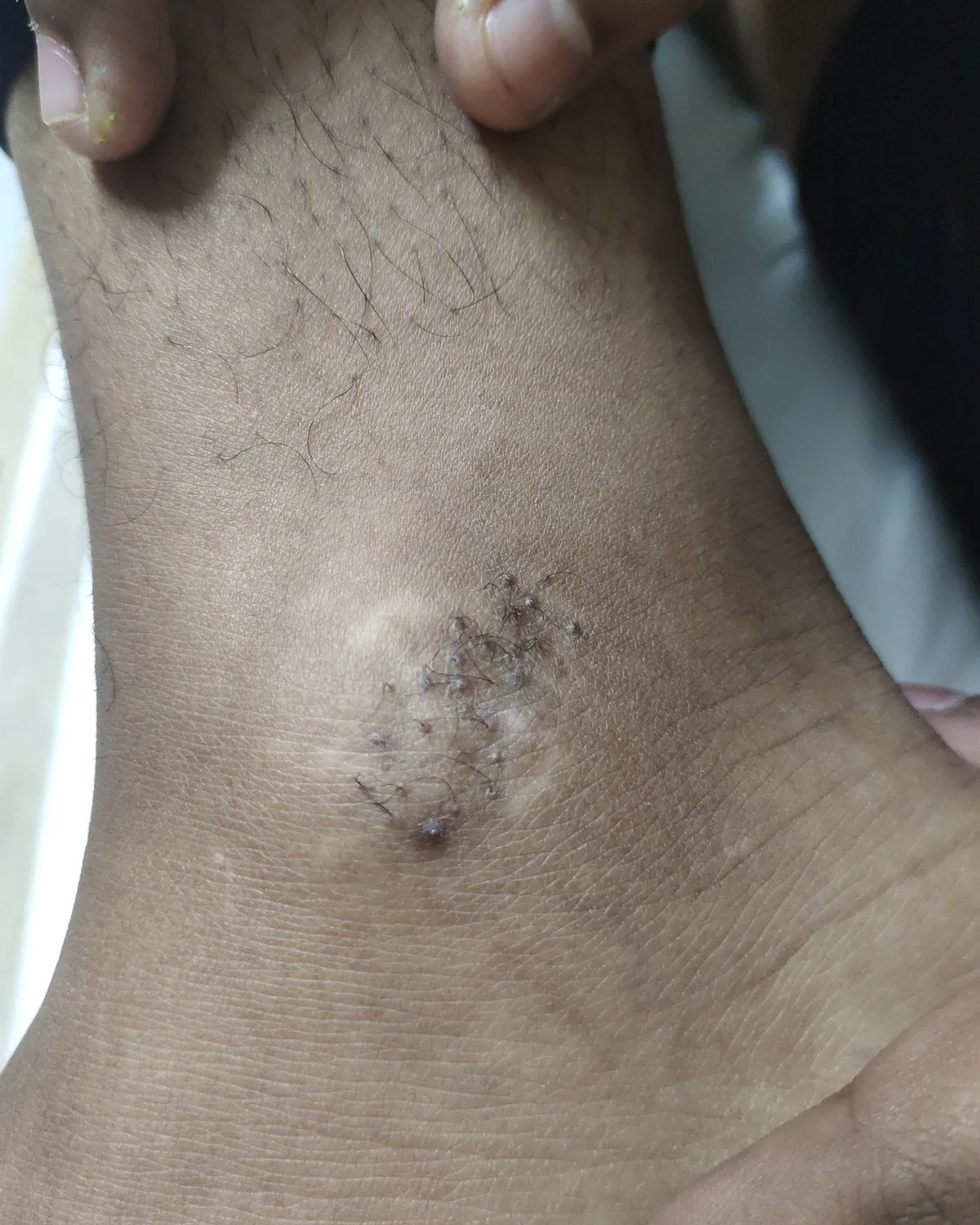 The same ankle patch with pigment spread out from each graft site, the pale area much reduced and mottled with darker skin.
