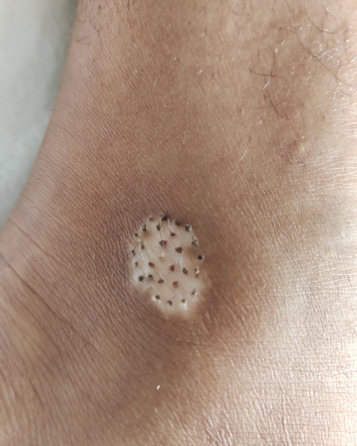 A pale patch on an ankle with a regular grid of small dark punch grafts set into it.