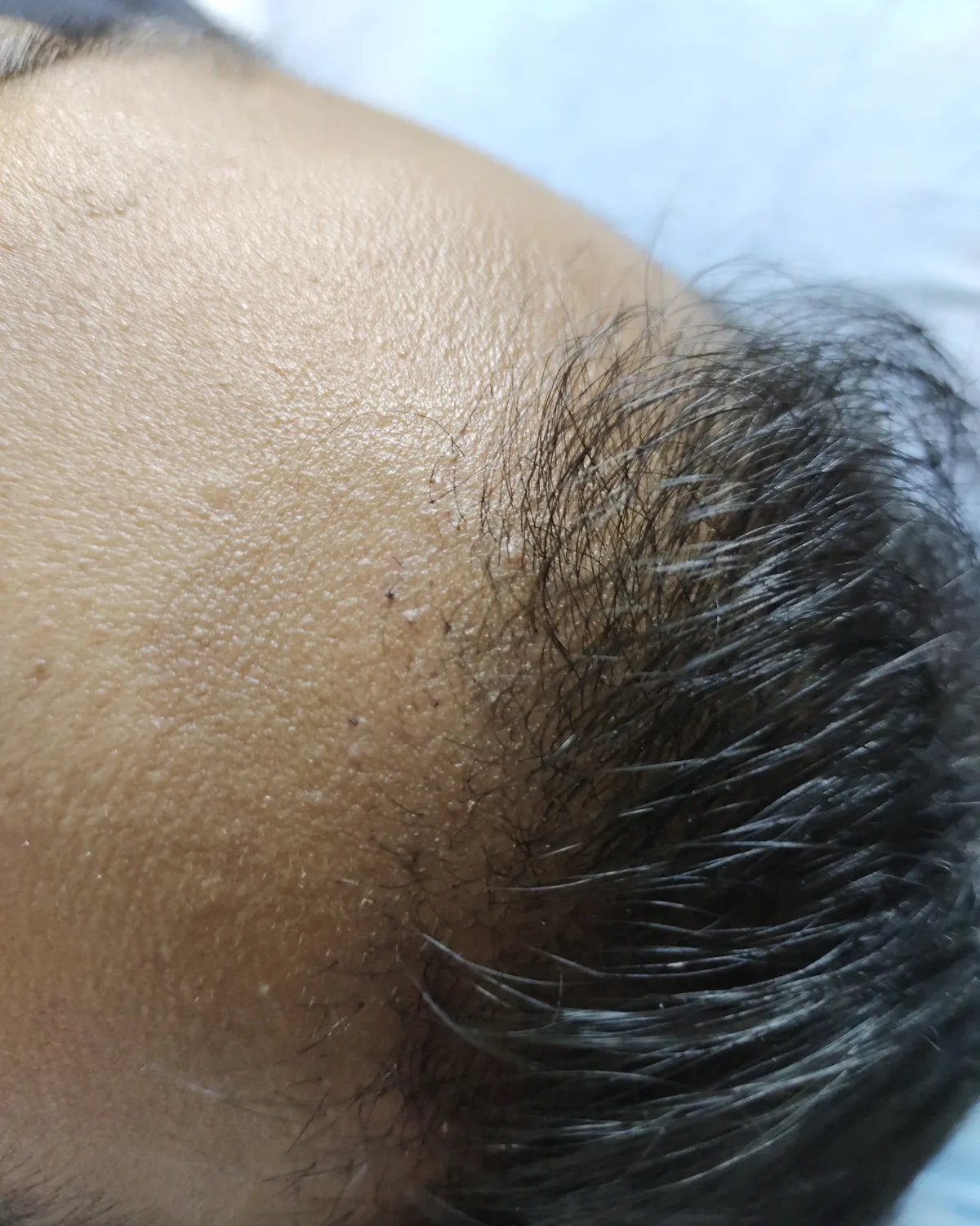 The temple and hairline at follow-up, with grafted hair growing along the front edge.