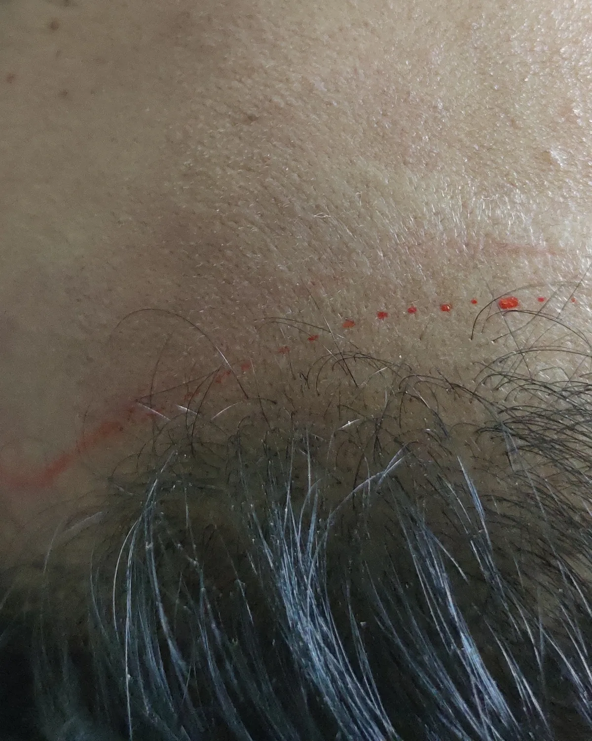 A forehead with a proposed hairline drawn across it in red surgical marker, hair below. Cropped above the eyes.