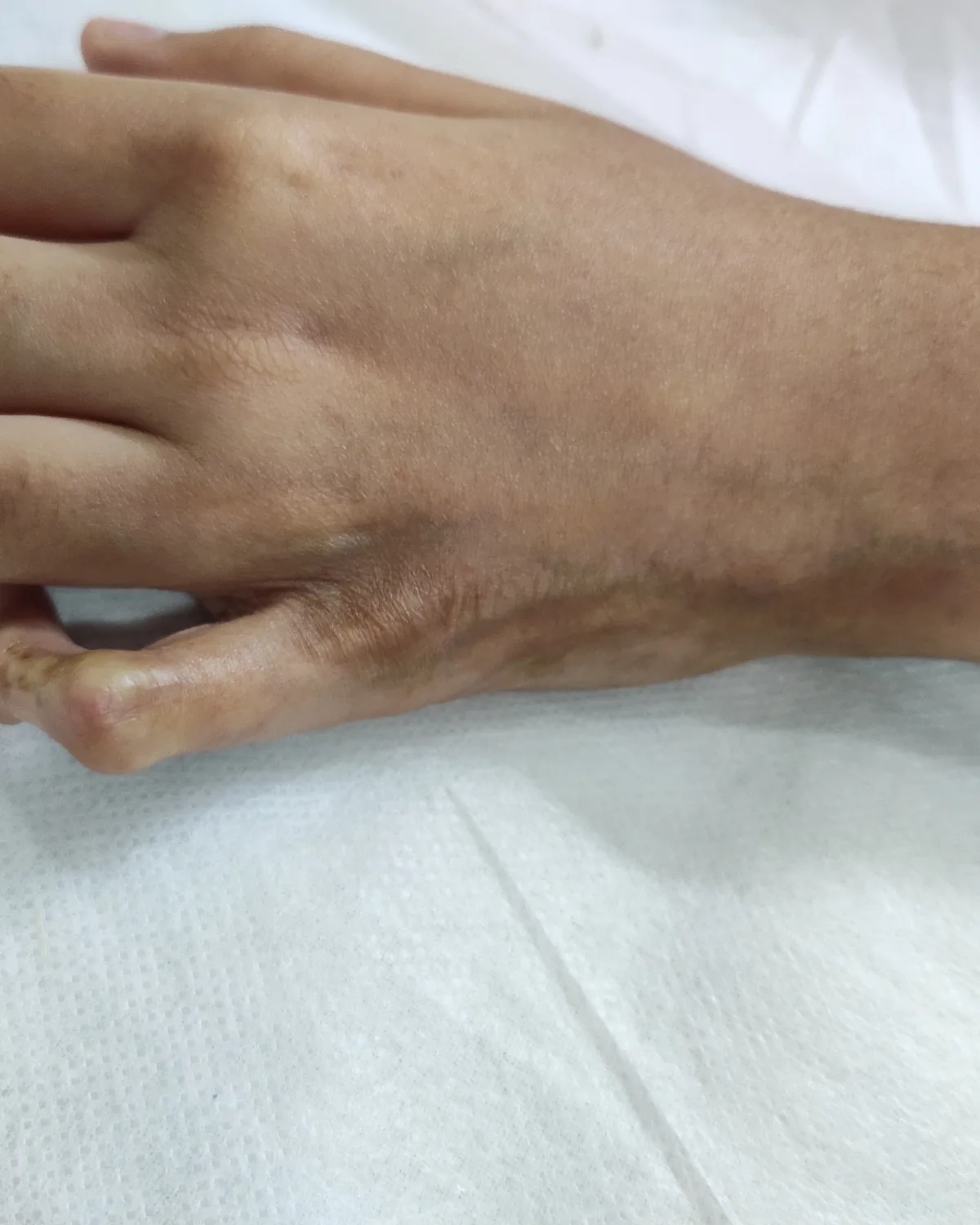 The same hand with the skin lying flat and slack, the linear tethering no longer visible.