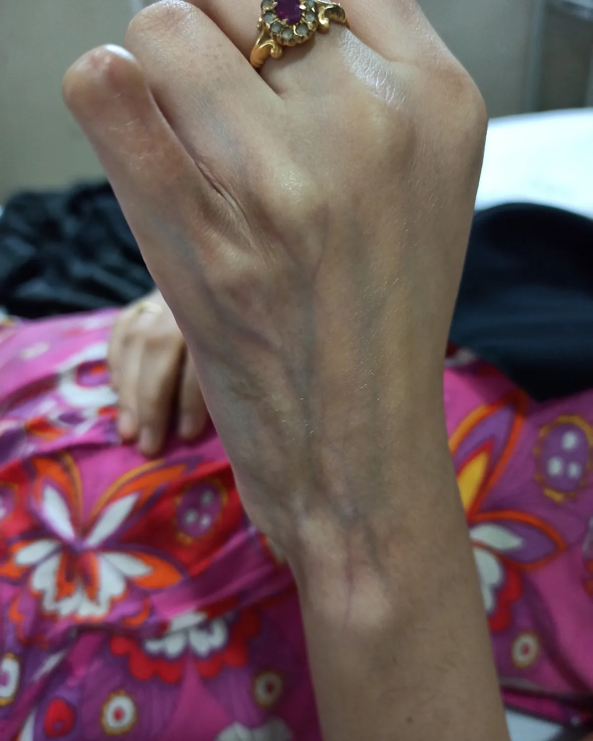 The back of a hand and wrist with taut, shiny, tethered skin drawn into linear bands running towards the fingers.