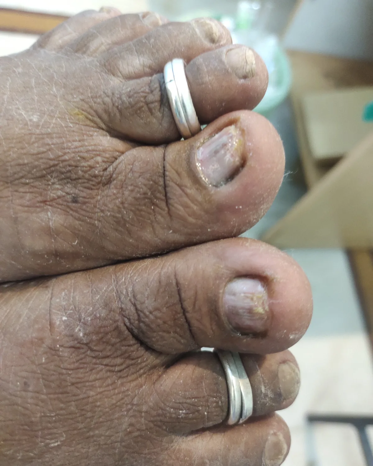 Both great toenails at follow-up, flat and attached to the nail bed with the crumbling resolved and some discolouration left.