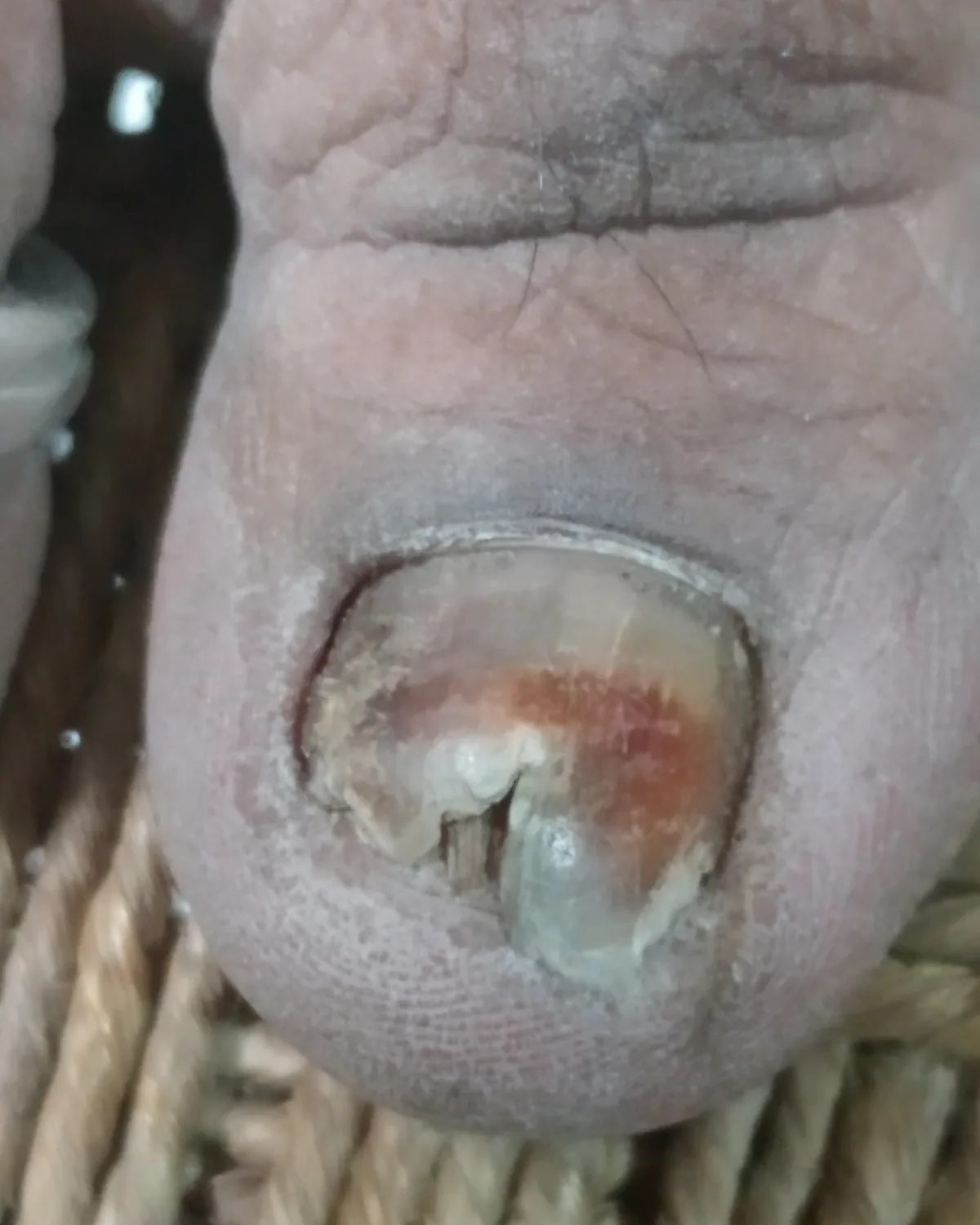 A great toenail thickened and crumbling, discoloured brown and yellow, lifted away from the nail bed.
