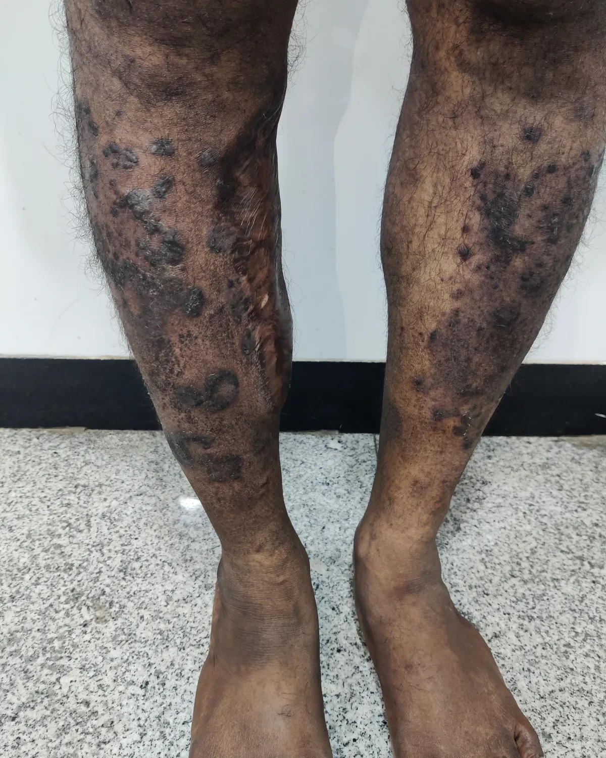 Both lower legs with numerous raised, scaly, dark plaques scattered from knee to ankle.
