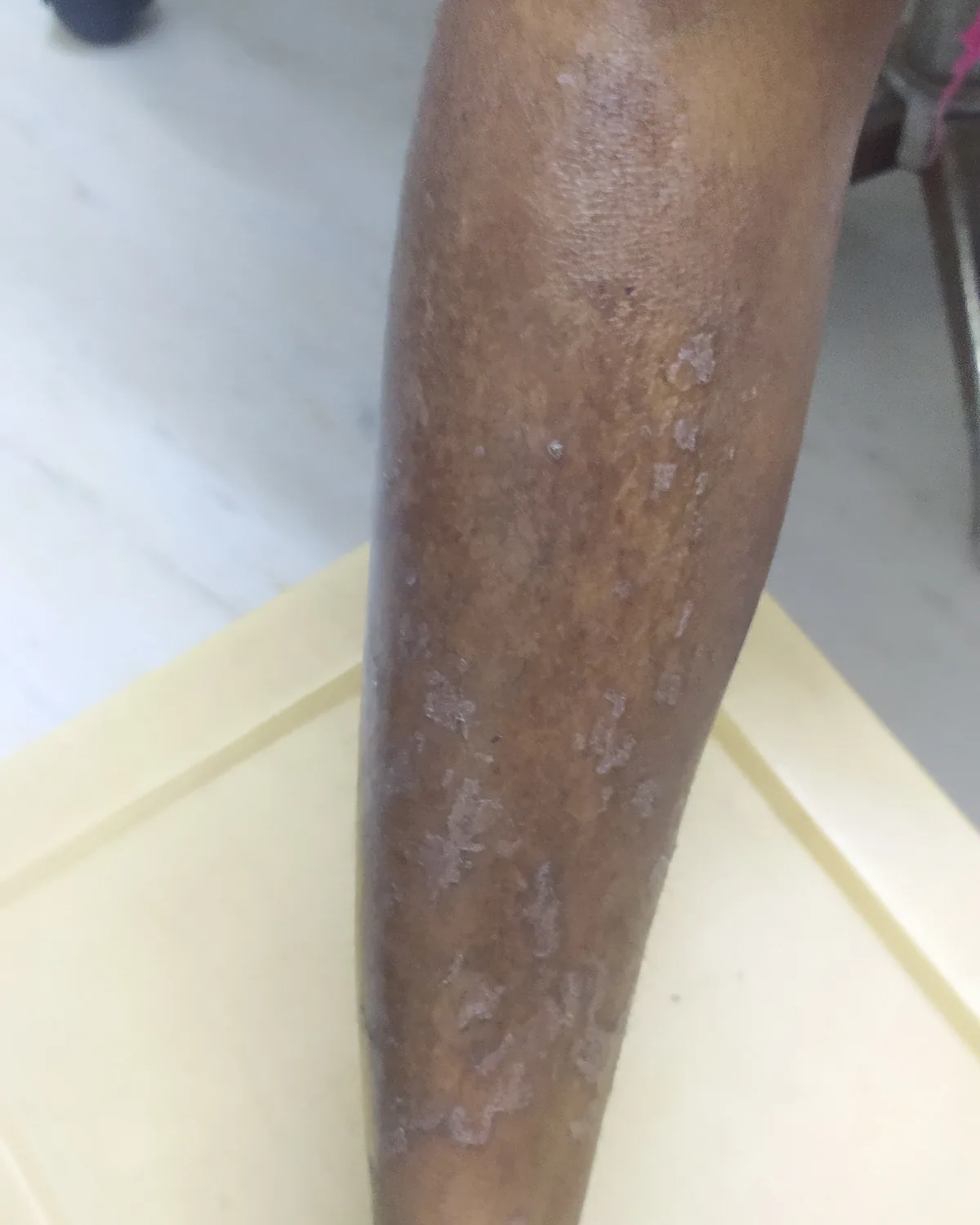 The same lower leg with the scale gone and the skin flat, showing faint residual marking where the plaque had been.