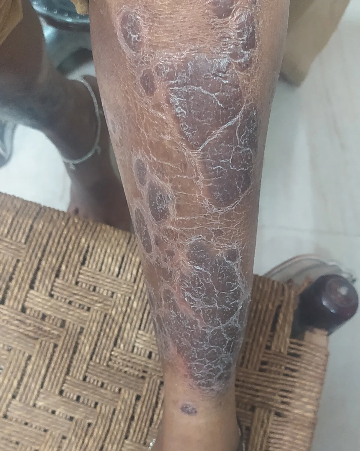 One lower leg largely covered by a thick, cracked, silvery-white scaling plaque from below the knee to the ankle.