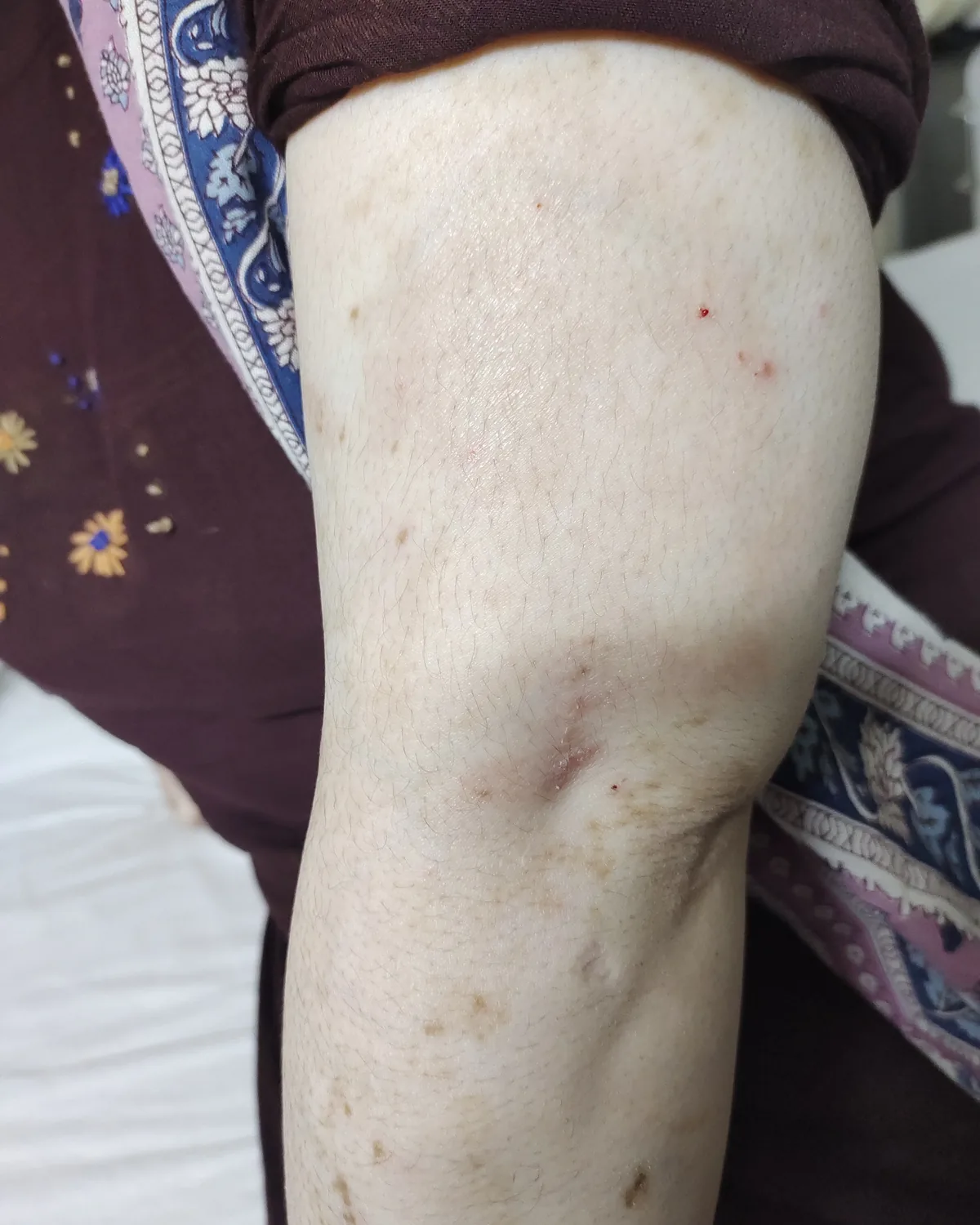 The same forearm in one even pale shade, the remaining brown islands no longer present.