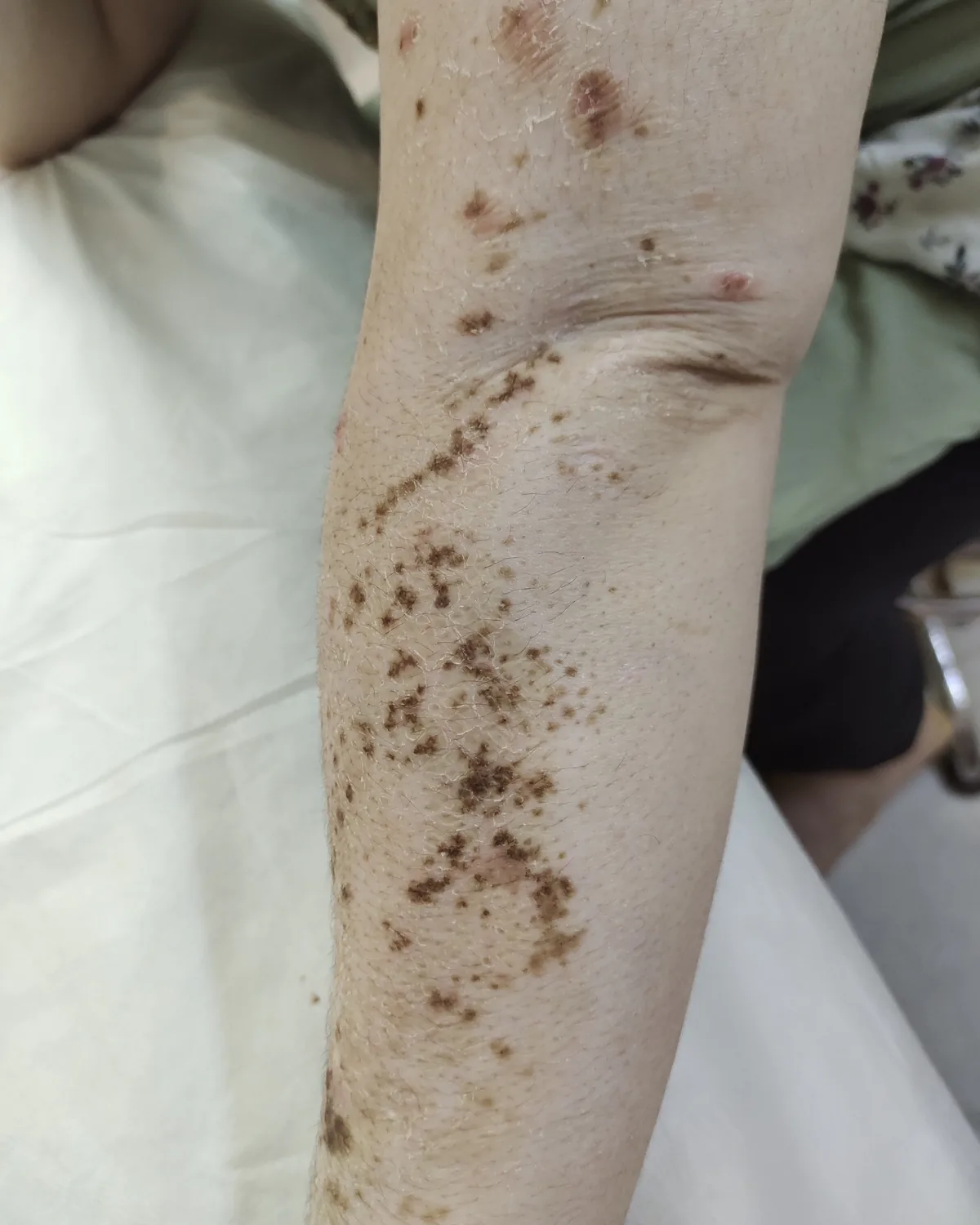 A forearm that is almost entirely pale, scattered with freckle-like islands and patches of the patient's remaining brown pigment.