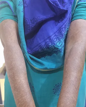 The same forearms in an even brown skin tone, with only faint pale marking left.